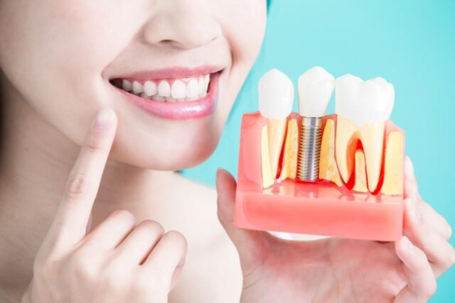 What to Consider Before Choosing a Permanent Tooth Replacement