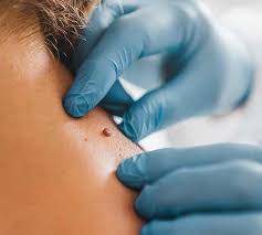 Moles Removal in Dubai: Procedure, Benefits, and Recovery
