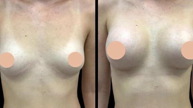 Best Breast Augmentation Surgeons in Dubai: Breast Augmentation Before and After Results