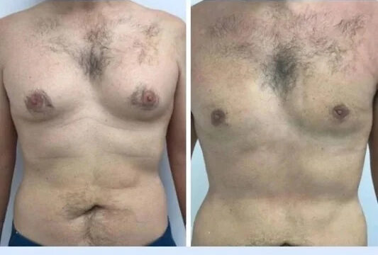 Gynecomastia in Dubai: Exploring Modern Surgical Approaches