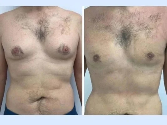 Gynecomastia in Dubai: Exploring Modern Surgical Approaches