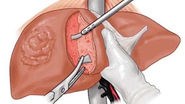 Liver Transplant Specialist in Noida for Transplant Care Guide