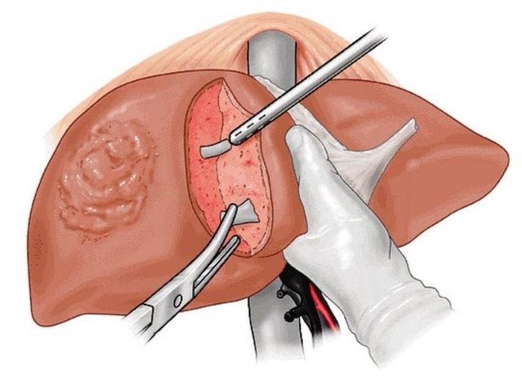 Liver Transplant Specialist in Noida for Transplant Care Guide